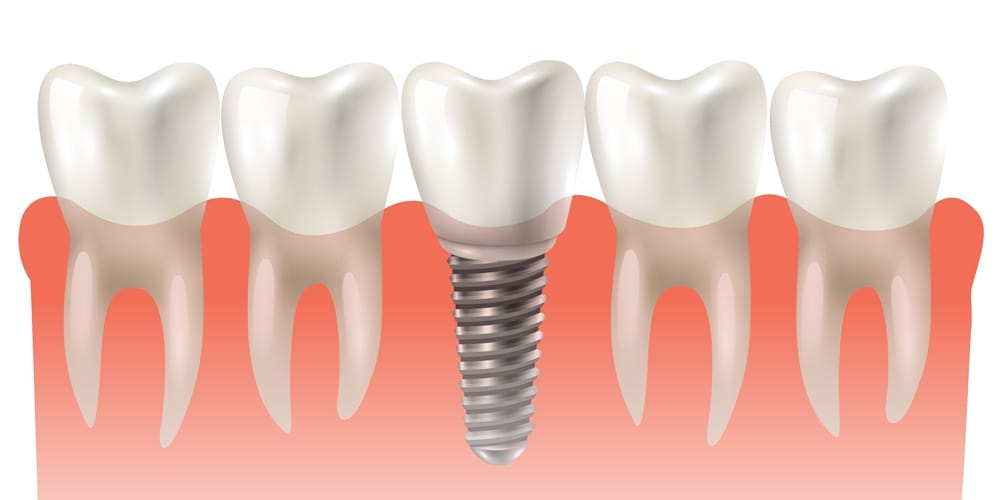 Dental Implant Turkey: Natural-Looking Tooth Replacement
