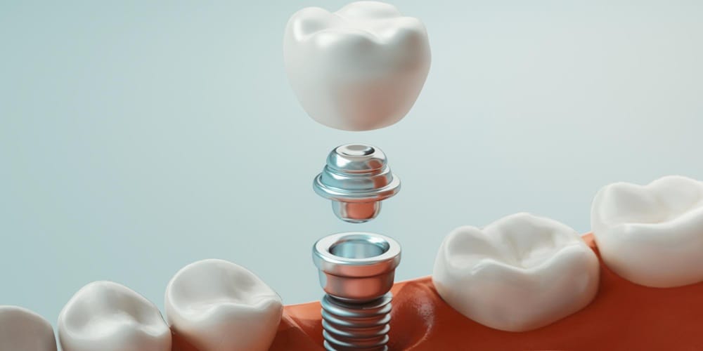 Dental Implant Turkey: Natural-Looking Tooth Replacement
