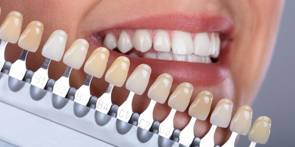 Hollywood Smile vs Zirconium Crowns: Which Is Better for You?