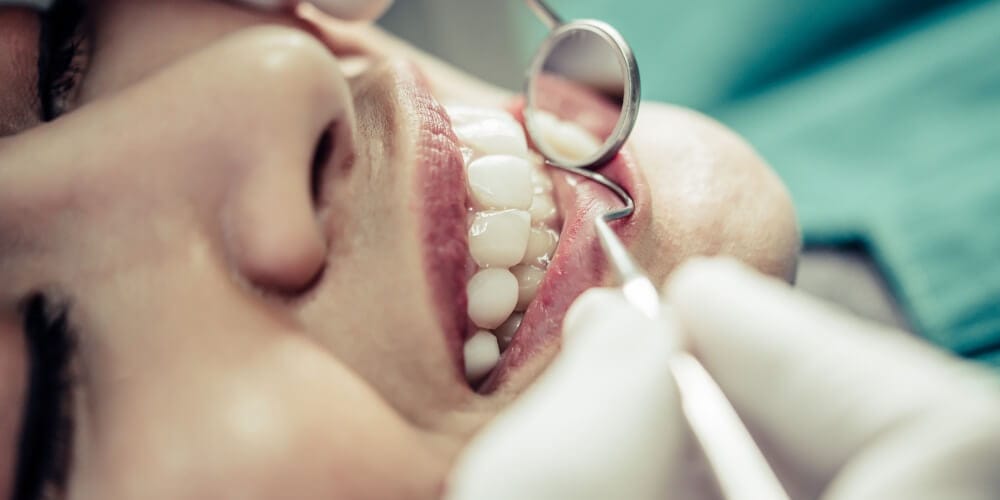 Rialzo del seno mascellare in Turchia: innesto osseo per impianti dentali