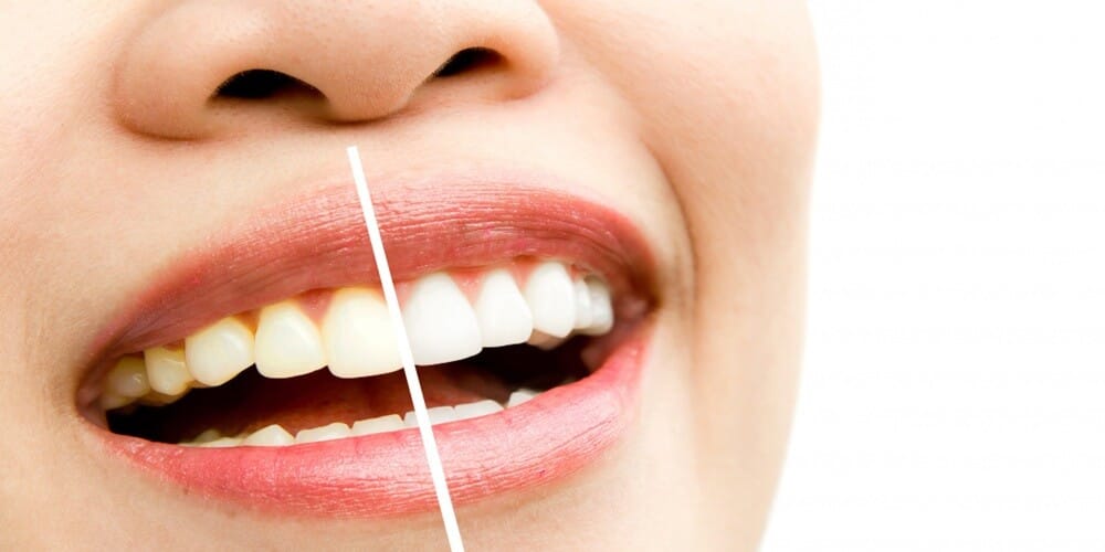 Professional Teeth Whitening in Türkiye for Stained Teeth