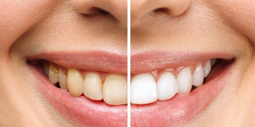 Professional Teeth Whitening in Türkiye for Stained Teeth